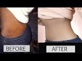 How To Get Rid of Stretch Marks Fast  Natural Remedies ...
