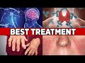 The Best Treatment for ALL Autoimmune Diseases