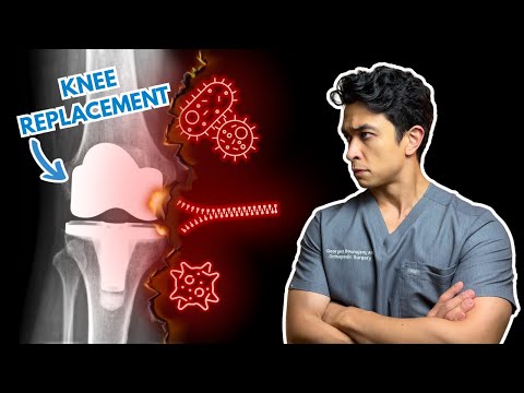 Knee Replacement Complications: Catch These Early