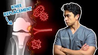 Knee Replacement Complications: Catch These Early