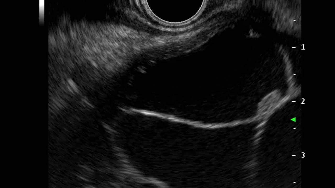 EUS Evaluation of Cystic Neoplasm Mucinous Cystadenoma PancreasMural