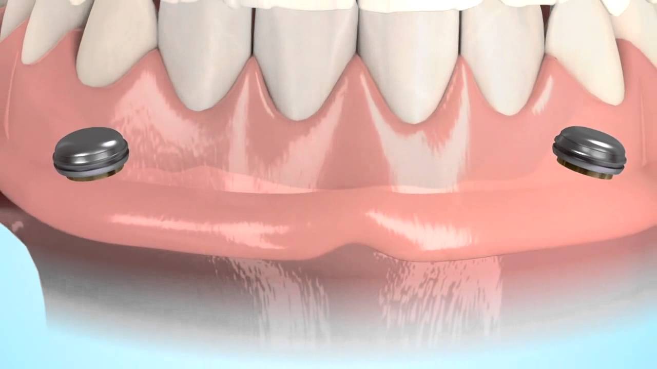 InPlace Dental Implant Retention for Dentures and Partials YouTube