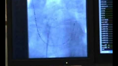 Obtaining Transseptal Access and Catheter Placement