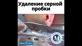 Удаление серной пробки из уха.