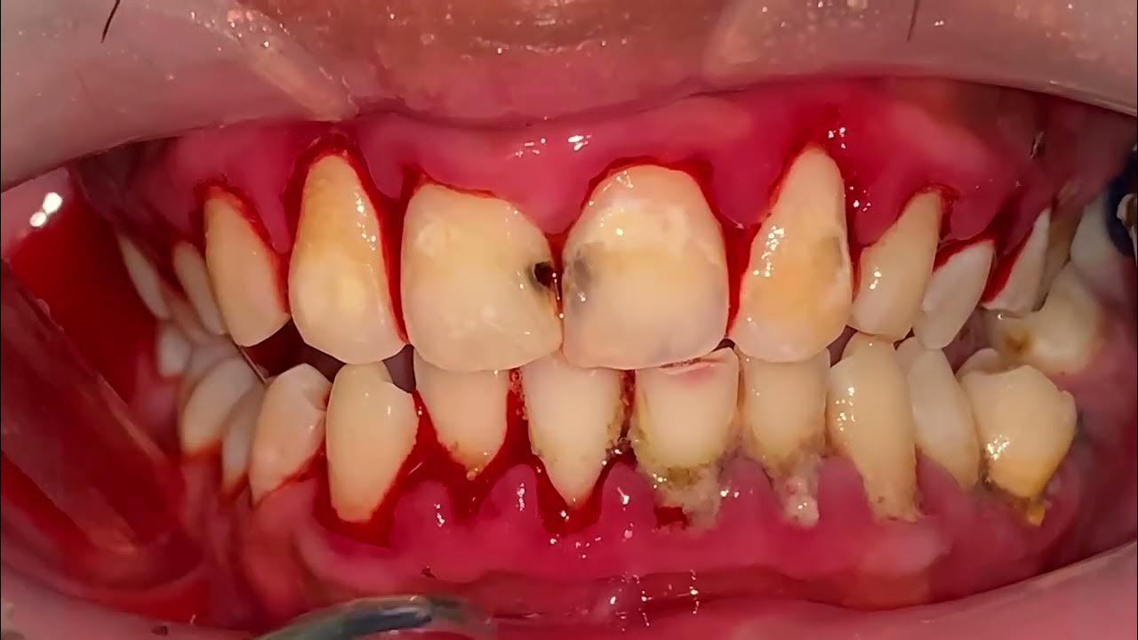 how to get plaque off teeth 4K UHD 23yo Males Teeth Scaling Tartar