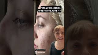 Food related ACNE