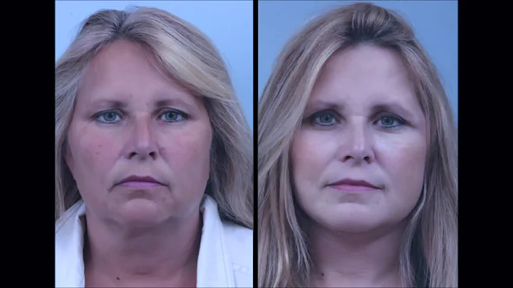 What is a Facelift?