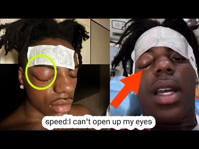 Is IShowSpeed okay? Streamer undergoes emergency surgery in