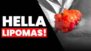 HELLA LIPOMAS!