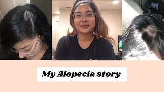 My alopecia story