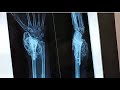 Giant Cell Tumor (GCT) of Wrist | Diagnosis, Surgery &amp; Treatment | Orthopedic Oncology