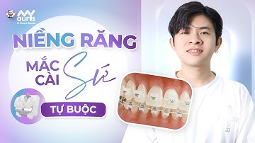 Niềng răng mắc cài sứ tự buộc ưu và nhược điểm