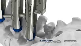 Captiva Spine:TowerLOX MIS Pedicle Screw System