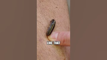 How to REMOVE A LEECH from your skin!
