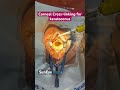 Treatment of keratoconus via Corneal Cross-linking #keratoconus #suneyecafe #eyecare