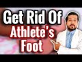 How to Treat Athlete's Foot FOR GOOD (2021)