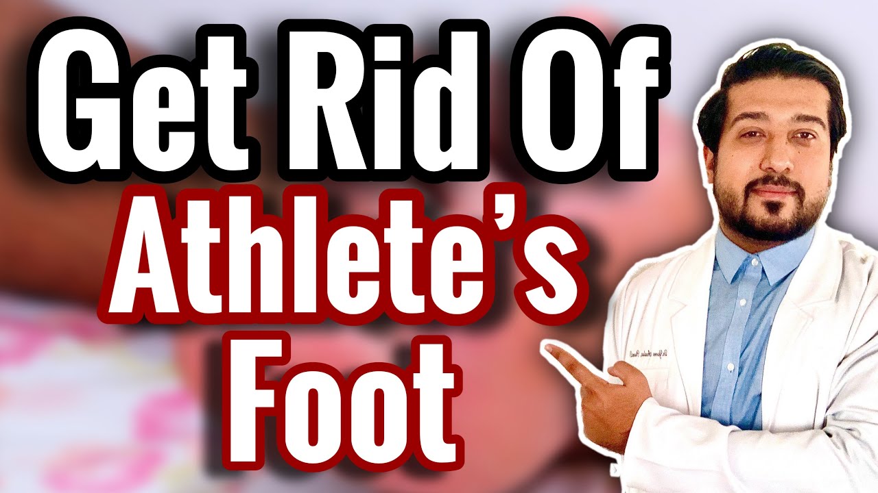 How to Treat Athlete's Foot FOR GOOD (2021) YouTube
