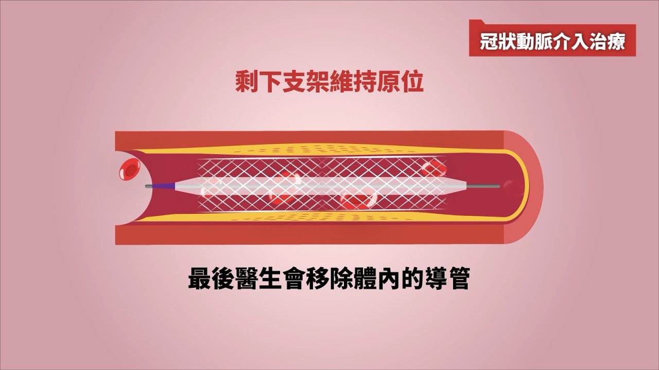 【香港亞洲心臟中心:通波仔過程暖心拆解】|通波仔真係咁得人驚?|拯救心臟病最強救星|隔日就可以出院? - YouTube