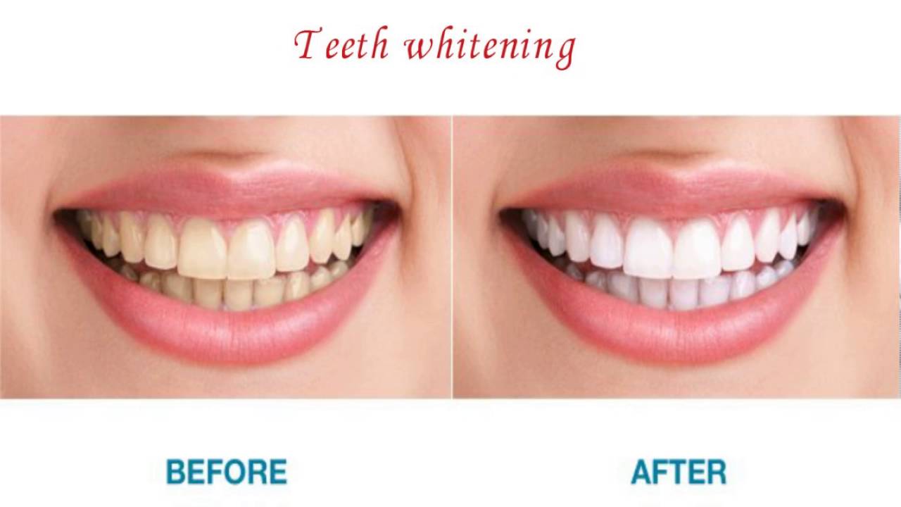 Family Dentistry Top Dental Clinic Salt Lake City Utah YouTube