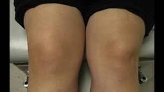 Calmar dolor rodilla el como hinchada de