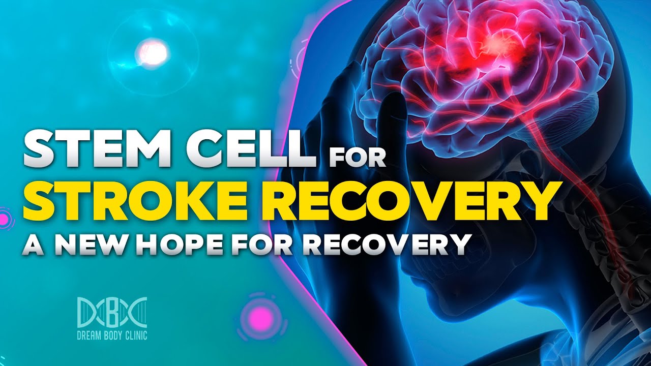 Stem Cells For Stroke Recovery. A New Hope For Recovery