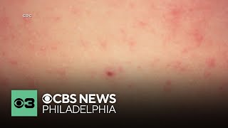 Full Officials investigating 3rd potential measles-related death in Pennsylvania Update