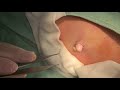 ⑪ 粉瘤くりぬき法 epidermal cyst atheroma cystic acne extractions 脂肪腫 lipoma クリニーク大阪心斎橋 大阪梅田院 名古屋院 福岡院