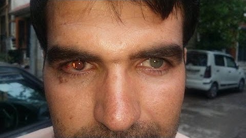 Iris reconstruction of traumatic aniridia Brightocular