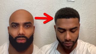 How To Keep Your Hairline Forever Anti Balding Routine