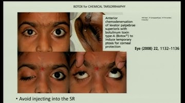 AIOC2018 - IC532 - Topic - Functional Indications other than spasms - Dr.Prerana Tahiliani