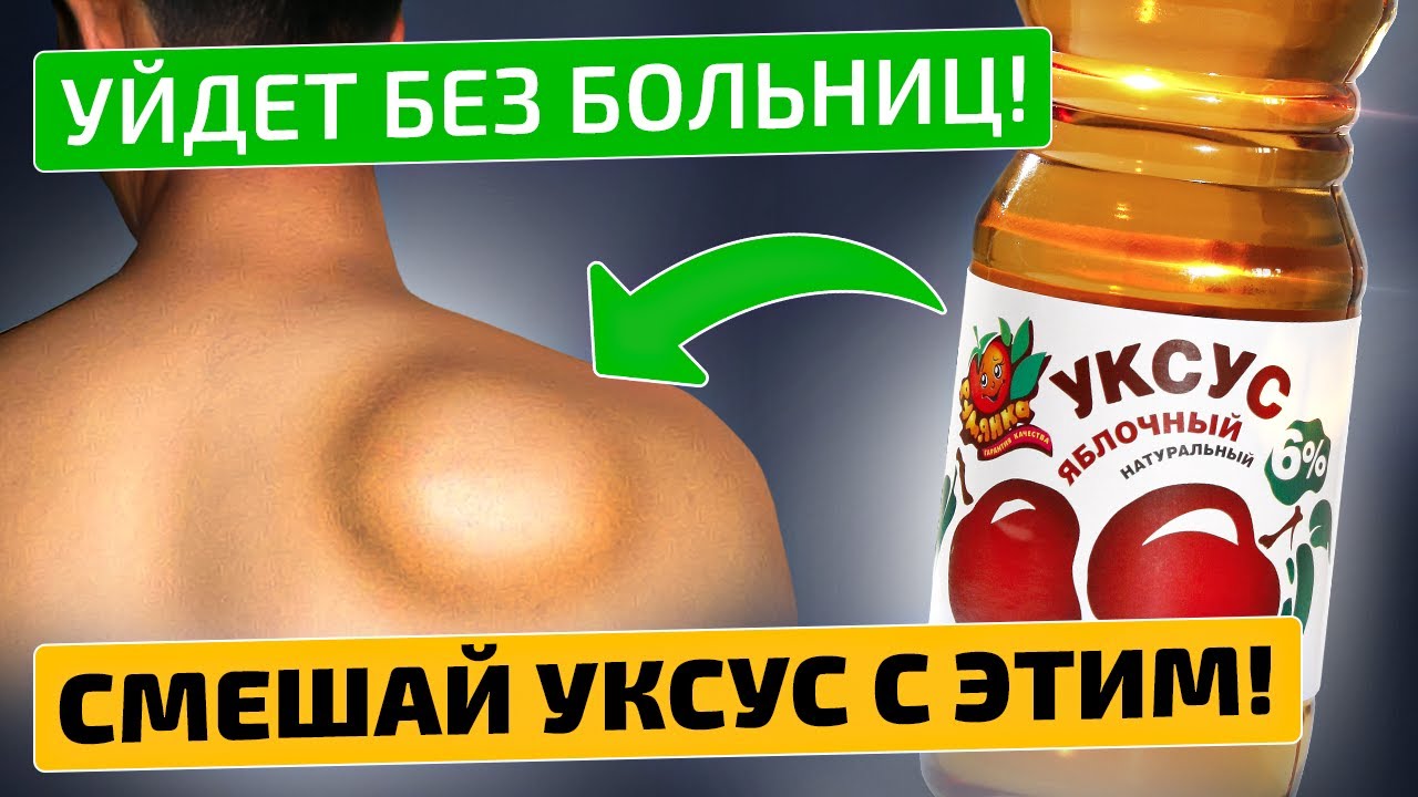 Старый хирург проболтался! Жировик (липома) исчезнет уже через ...