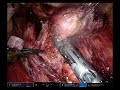 Thyroid tumor excision using firefly davinci baba