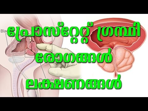 പ്രോസ്റ്റേറ്റ് ഗ്രന്ഥി രോഗങ്ങൾ ലക്ഷണങ്ങൾ, Prostate diseases symptoms | Dr R Vijayan | Arogyavicharam