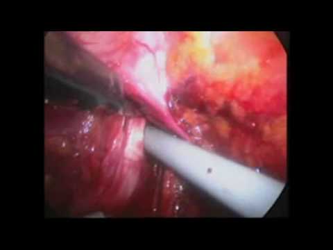 intervento prostata in laparoscopia video clips intervento prostata in laparoscopia video clips