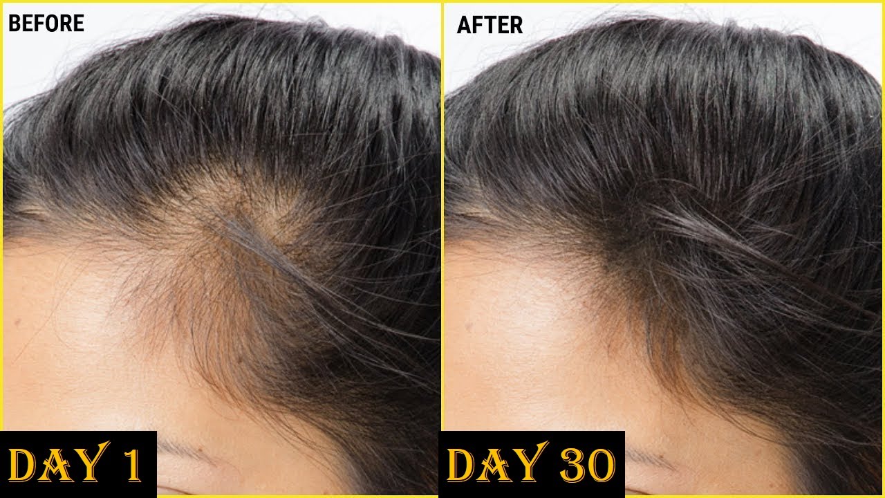 Grow Hair On Front Forehead Using castor oil/ castor onion oil - YouTube Grow Hair On Front Forehead Using castor oil/ castor onion oil - YouTube