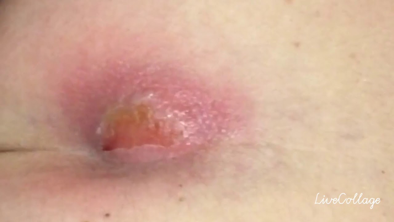 Pilonidal Cyst Symptoms, Treatments, Surgery Pilonidal Cyst Symptoms, Treatments, Surgery