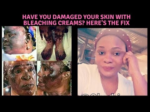 How To Fix Mercury Bleaching Cream Burn
