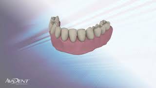 AvaDent Snap-Pin Bar