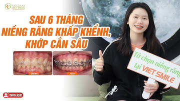 Niềng răng khấp khểnh, khớp cắn sâu sau 6 tháng thay đổi ra sao?