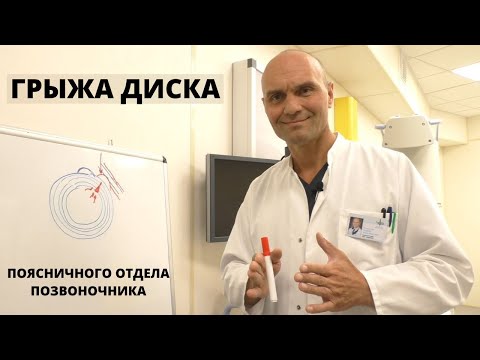 ГРЫЖА ДИСКА ПОЯСНИЧНОГО ОТДЕЛА ПОЗВОНОЧНИКА: опасно ли это? Как лечить позвоночник без операции?