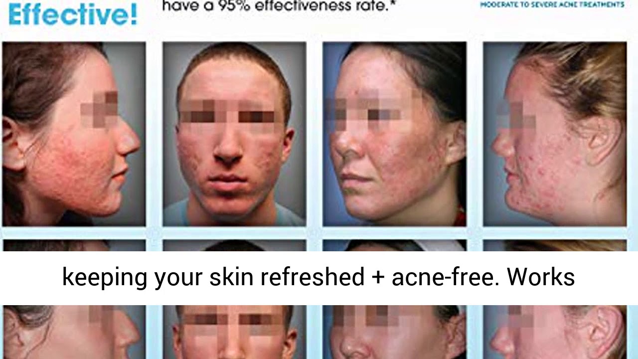 Neutralyze Exfoliating Pads 100 Pads Maximum Strength Acne Treatment