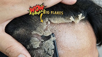 Itchy Dry Scalp Scratching Dandruff Big Flakes #1225