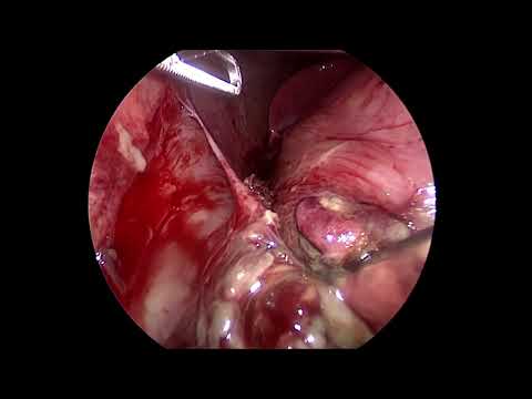 gangrenous appendix  with  sloughed base