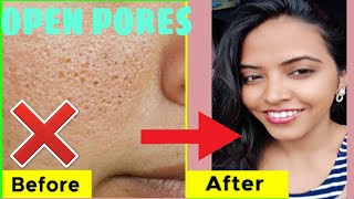 open pores treatment at home |results in 3 days|