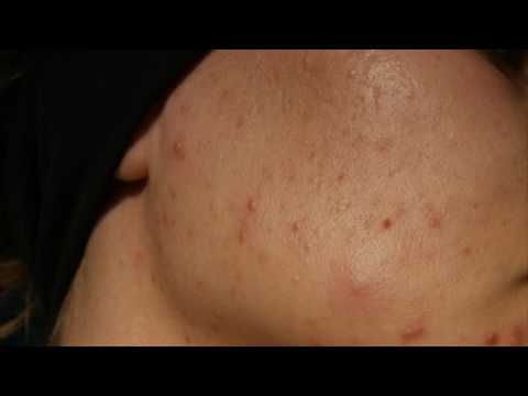 Подкожные прыщи. Как устранить их