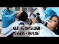 FINALLY GETTING MY TEETH FIXED | #Vlog | CreamyJoy #Invisalign