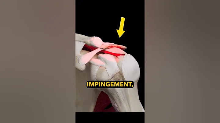 Shoulder Impingement? 2 Things You NEED to Know!
