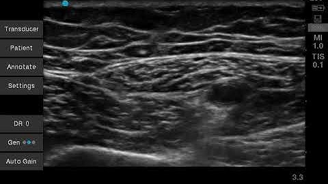 adductor canal block video   vastus medialis nerve