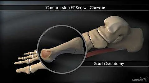 Headless Compression Screw – Chevron Animation