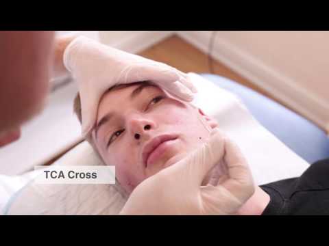 Acne scar treatment with subcision, TCA cross, and fractional CO2 laser